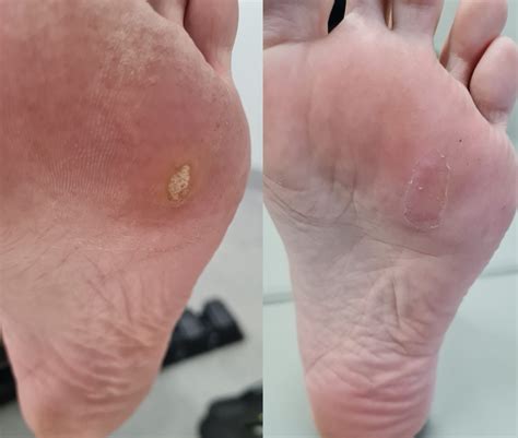 Plantar Wart For 15 Years at Mario Anderson blog