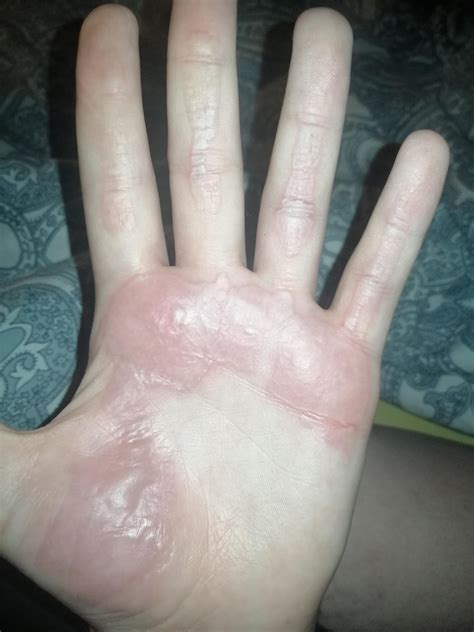 Idk if these are welcome here but I got a first degree burn on Thursday ...