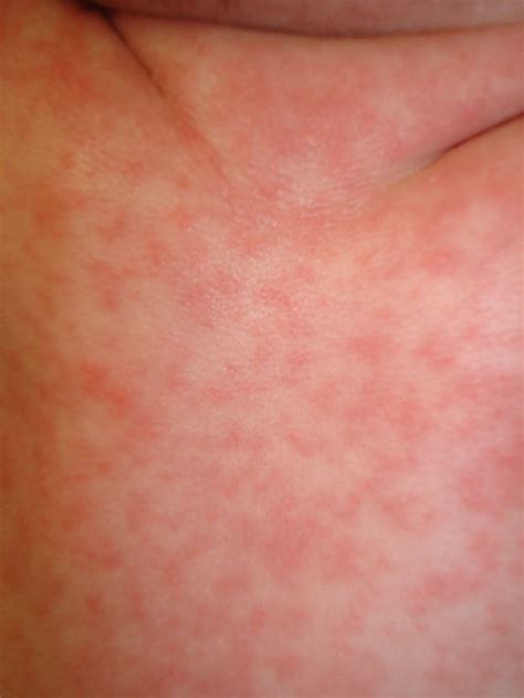 Roseola Virus and Rash After Fever: What to Do
