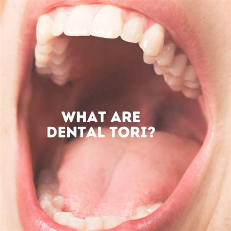 Torus Mandibularis Cancer