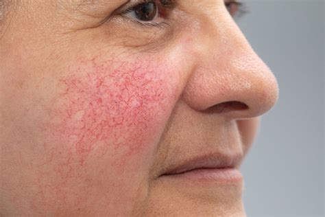 Rosacea Treatment & Management - VIDA Dermatology