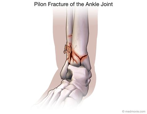 Pilon Fracture of the Ankle Joint - Medmovie.com