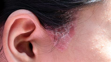 Plaque Psoriasis Ear