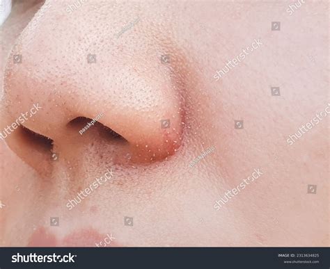 Acne Problem Comedones Enlarged Pores On Stock Photo 2313634825 | Shutterstock
