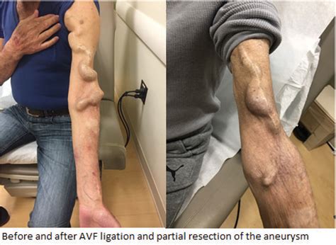 HIGH OUTPUT HEART FAILURE SECONDARY TO HEMODIALYSIS ARTERIOVENOUS ACCESS | JACC