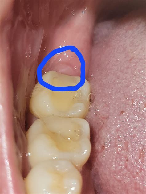 Painless soft bump, 4 months after wisdom teeth extraction : r/askdentists