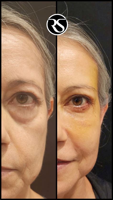 Face Reshape Surgery