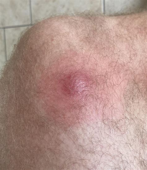 Spider bite : r/australia