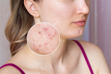 Cropped shot of young womans face with acne skin in zoom circle pimples red scars rash on cheeks ...