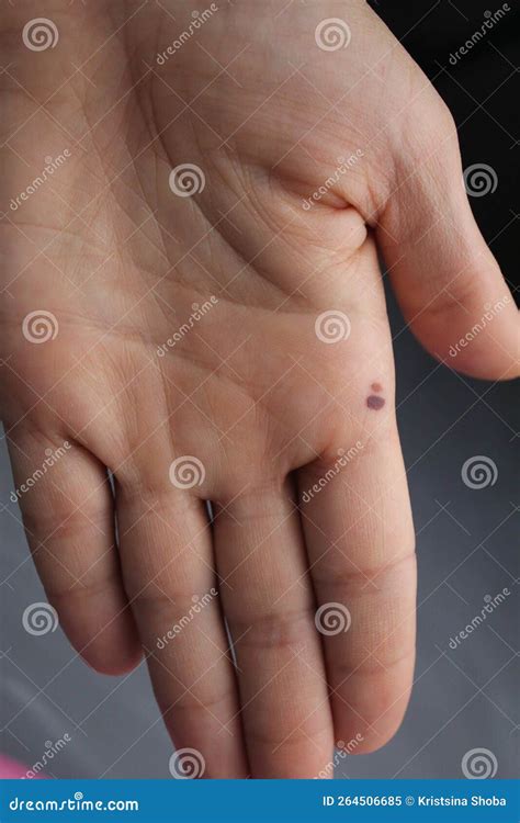A Flaw in the Skin on the Hand of the Palm. Bruising Bruise Mole Close ...