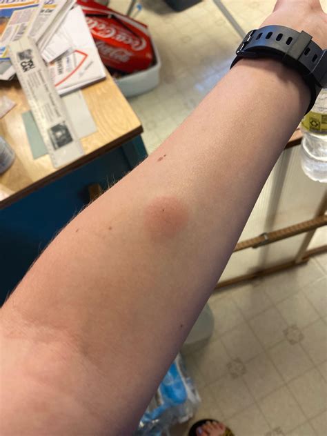 Tb Test Positive Looks Like