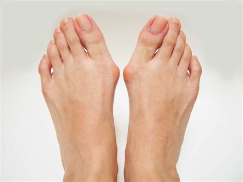 What Does Bunion Pain Feel Like? - Adelaide Foot and Ankle