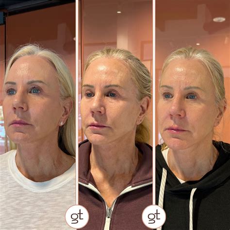 Before and After Gallery Dermal Fillers - Stunning Transformations