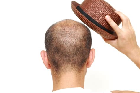 Does Wearing A Hat Backwards Cause Hair Loss at Roger Monday blog
