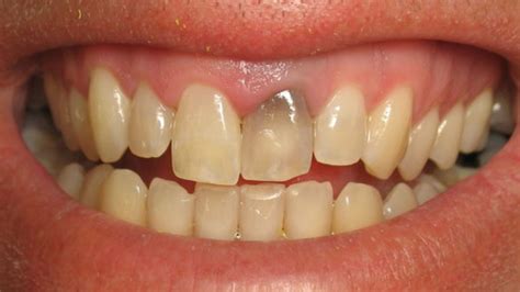 Light Grey Marks On Teeth at Christopher Carr-boyd blog