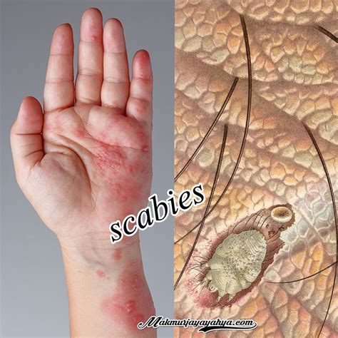 Penyakit scabies, pencegahan dan penanganannya - Makmur Jaya Yahya