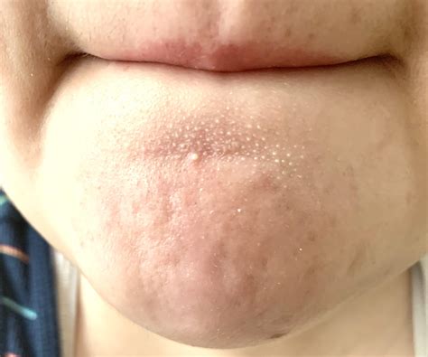 Milia Acne On Chin at Viola Joy blog
