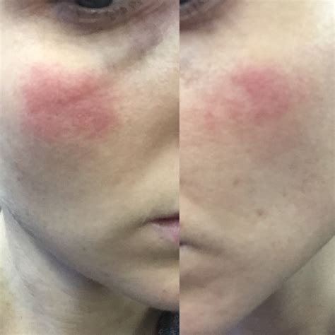 Rash On Face During Pregnancy