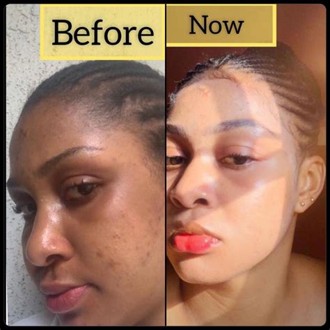 Lets Talk Skin Lightening: Your Friendly Guide