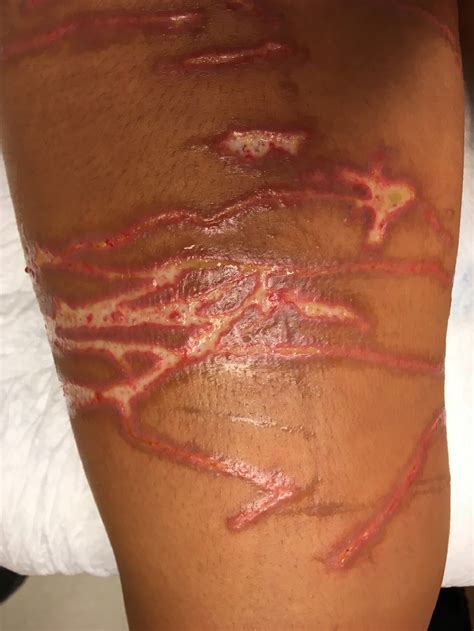 Sting Of Box Jellyfish