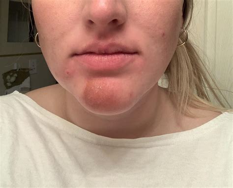 beard rash from kissing - Caption Simple