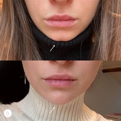 A more V-shaped face with Chin Filler | Chirurgie, Contouren, Gezicht