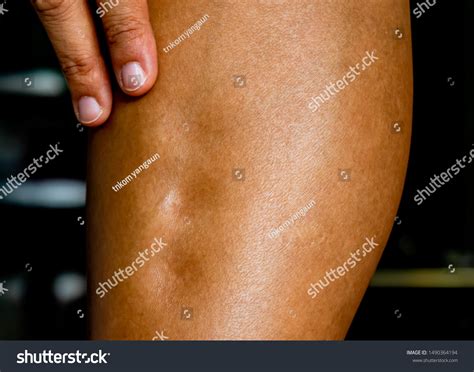 Pitting Edema On Patient Leg Primary Stock Photo (Edit Now) 1490364194