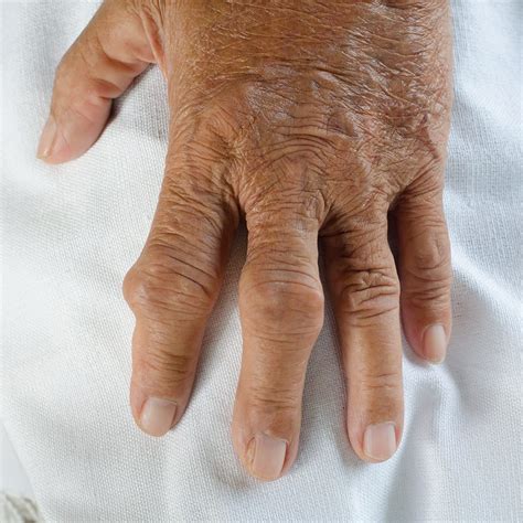 Gout in the Hand - Hand Specialist Brandon P. Donnelly, MD