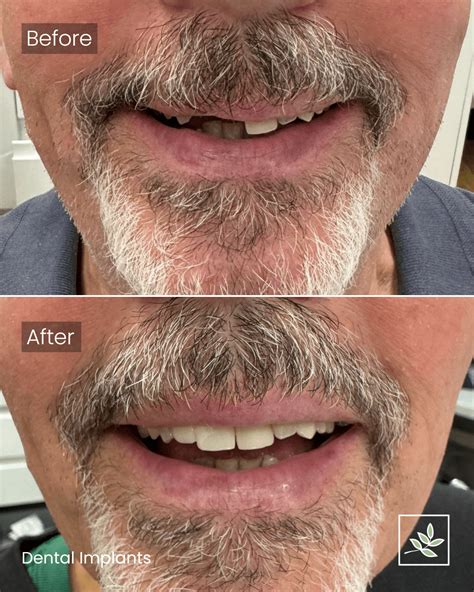 The Dental Team Manchester | Dental Implants in Manchester