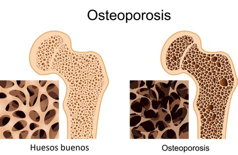 La Osteoporosis