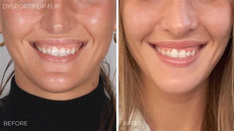 Lip Flip Botox Dublin at Rebecca Castillo blog