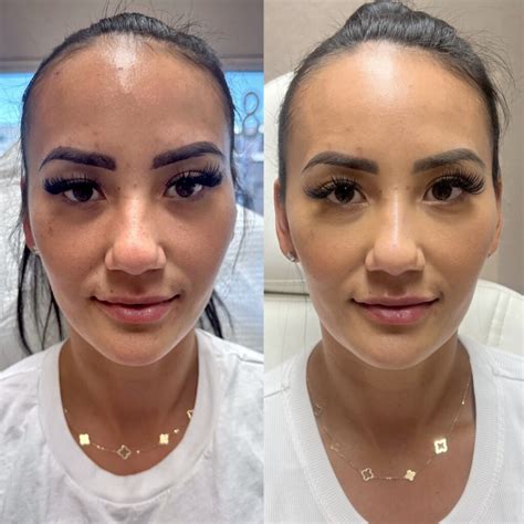 What Is A Nose Thread Lift at Erminia Heavner blog