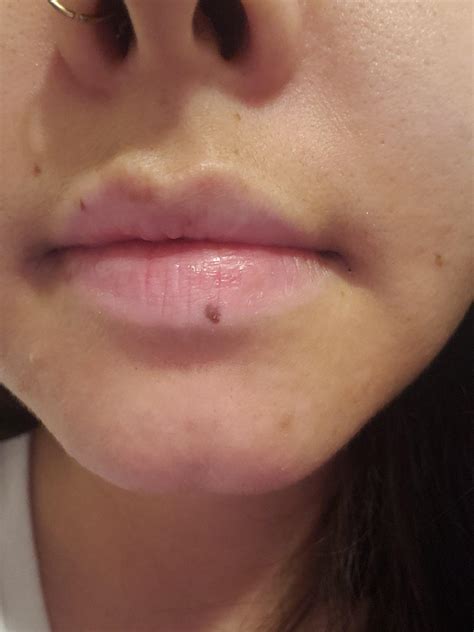 Is this a mole? Showed up about a year ago on my bottom lip and has been growing since. Not sure ...