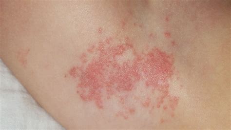 What Seniors Should Know About Shingles - McGuffey Healthcare