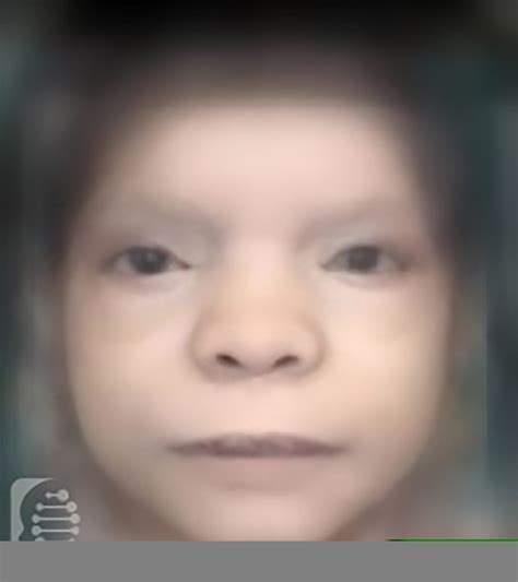 What Causes Barber Say Syndrome at Luis Lam blog