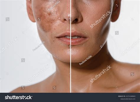 2,886 Pigmented Skin Before And After Images, Stock Photos & Vectors ...