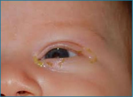 Clinical Medicine- Pediatrics (Eyes) Flashcards | Quizlet