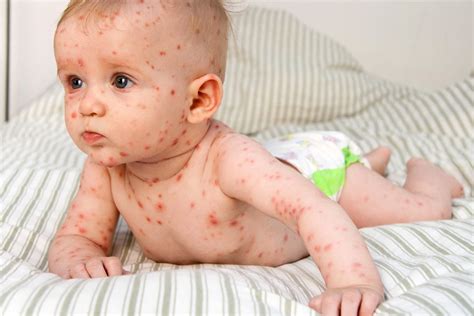 Viral Exanthem