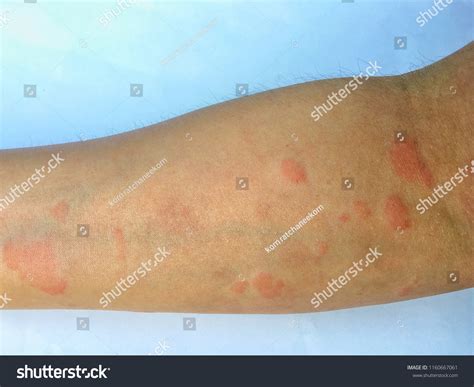 333 Sle Symptoms Images, Stock Photos & Vectors | Shutterstock