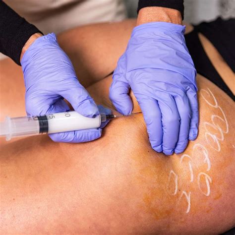 Nonsurgical BBL | Franklin, TN | BellaVi Spa & Aesthetics