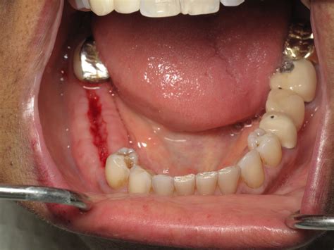 Tooth Extraction With Bone Graft And Stitches at Cameron Kopsen blog