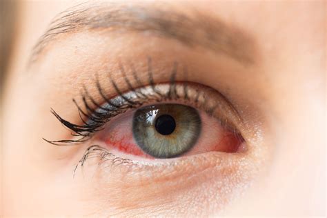 4 Types of Eye Allergies and 3 Ways to Treat Them