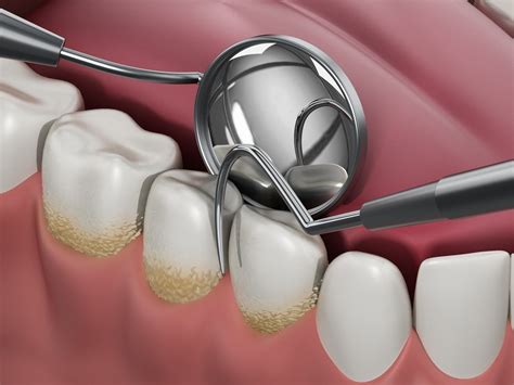Plaque vs. Tartar: Difference and Prevention