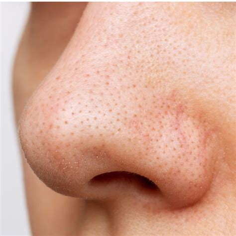 Sebaceous Filaments Treatment | Sebaceous Filaments vs Blackheads