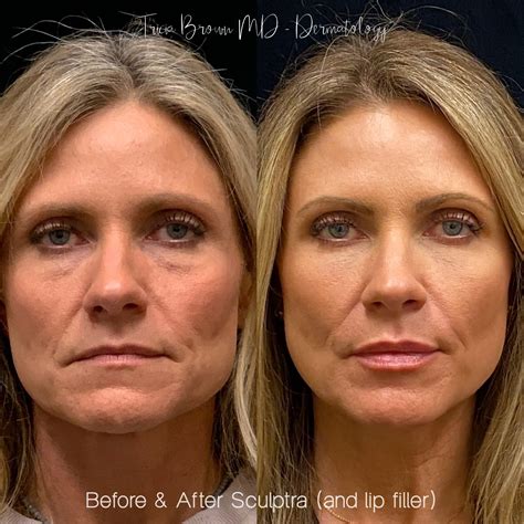 Facial Volume with Sculptra - Houston, TX Dermatologist