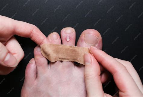 Premium Photo | Callus blisters on feet man is applying antiseptic ...