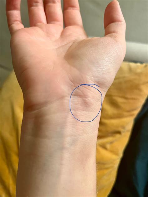 Patient with radial wrist pain- s/p low-impact FOOSH injury ~6 weeks ago. Urgent care ruled out ...