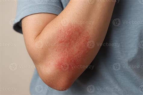 Close up of a human arm with a red, scaly skin rash on the inner elbow ...