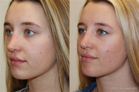 Eric M. Joseph, MD | Non-Surgical Rhinoplasty Before & After ...