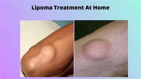 PPT - Lipoma Treatment Without Surgery - Lipoma Wand PowerPoint Presentation - ID:8382639